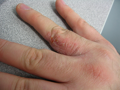 Exemplo de Dermatite Atópica